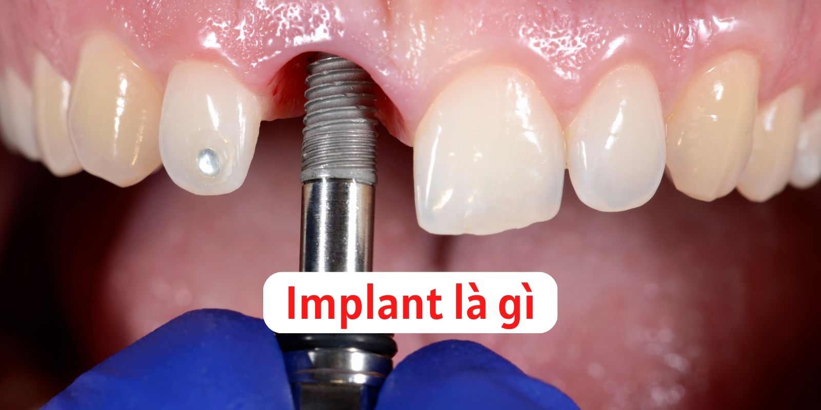 Implant là gì? Trồng răng Implant và các cụm từ liên quan